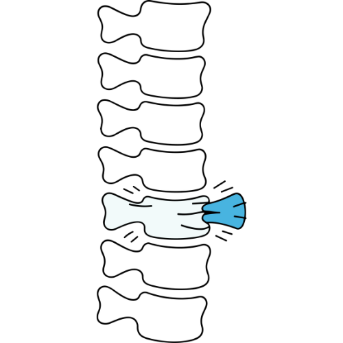 Disc Herniation Surgery